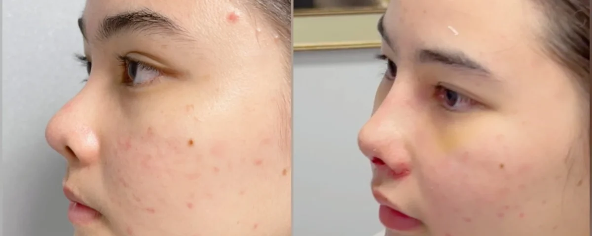 Revision Asian Rhinoplasty in Istanbul