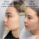Revision Asian Rhinoplasty in Istanbul