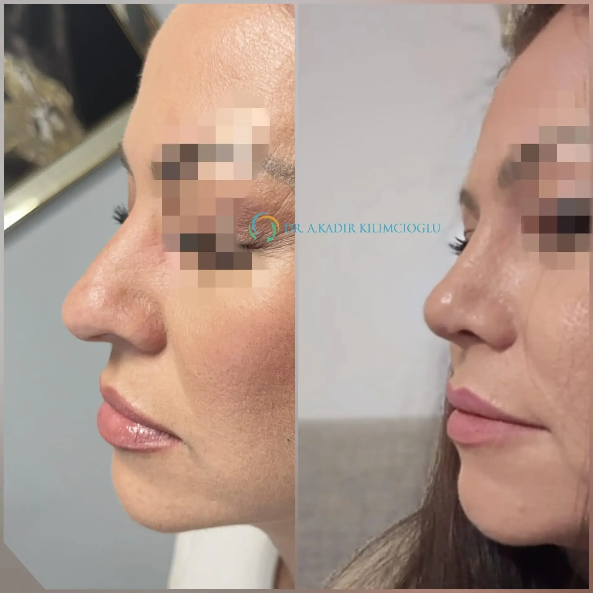 Before-and-After-Ethnic-Hispanic-Male-Rhinoplasty-in-Turkey