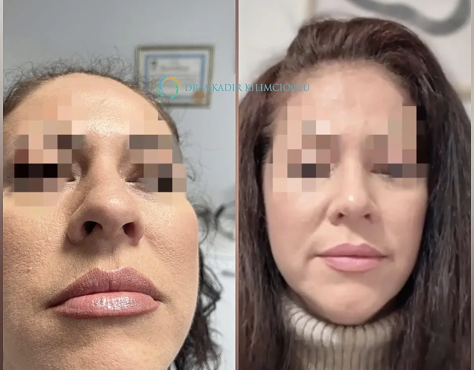 Before-and-After-Ethnic-Hispanic-Male-and-Female-Rhinoplasty-Turkey