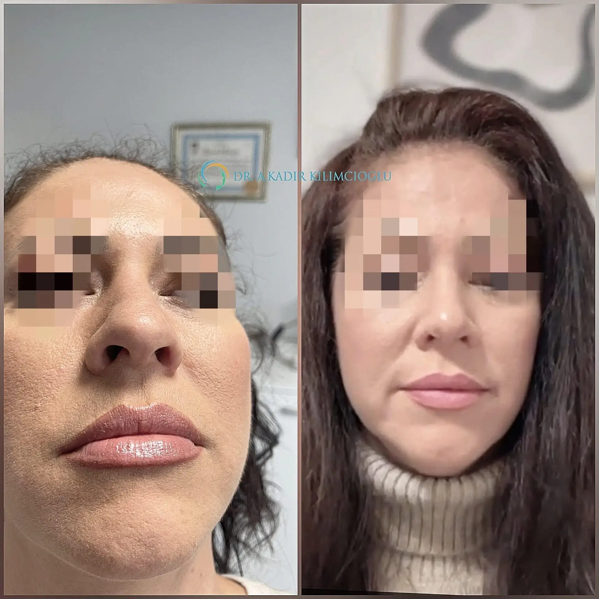 Before-and-After-Ethnic-Hispanic-Male-and-Female-Rhinoplasty-Turkey