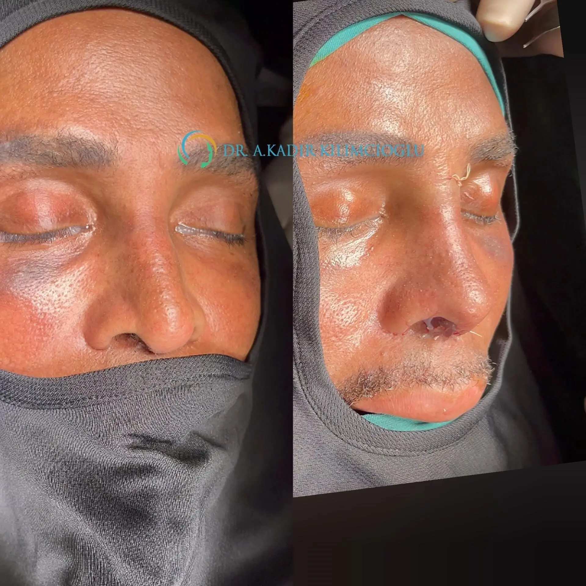 Before-and-After-Ethnic-Hispanic-Male-and-Female-Rhinoplasty-Turkiye