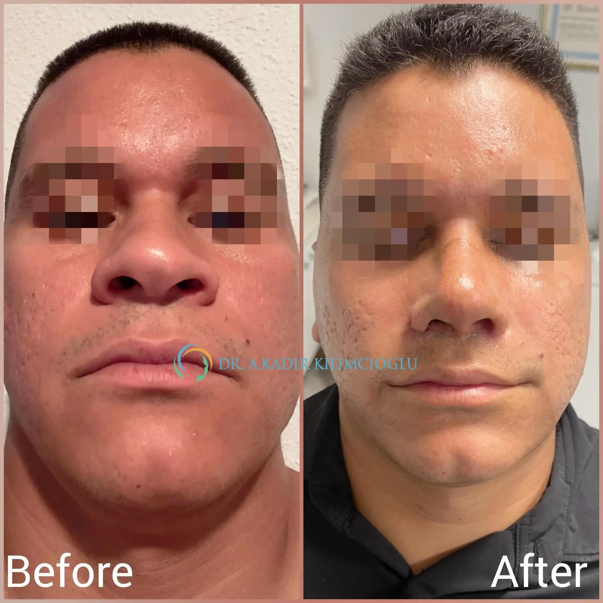 Before-and-After-Ethnic-Hispanic-Male-and-Female-Rhinoplasty-in-Turkey 