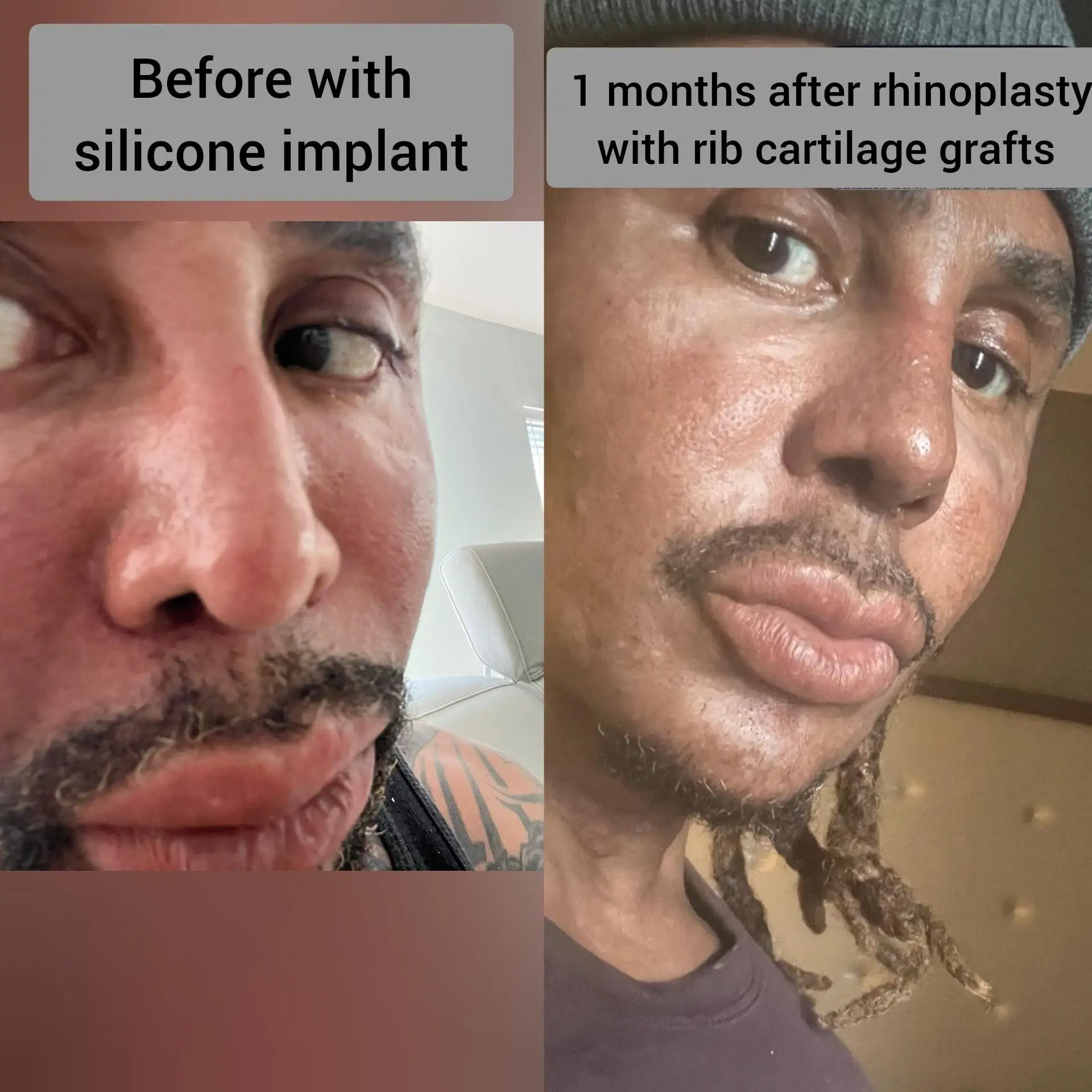 Before-and-After-Ethnic-Hispanic-Male-and-Female-Rhinoplasty-in-Turkiye