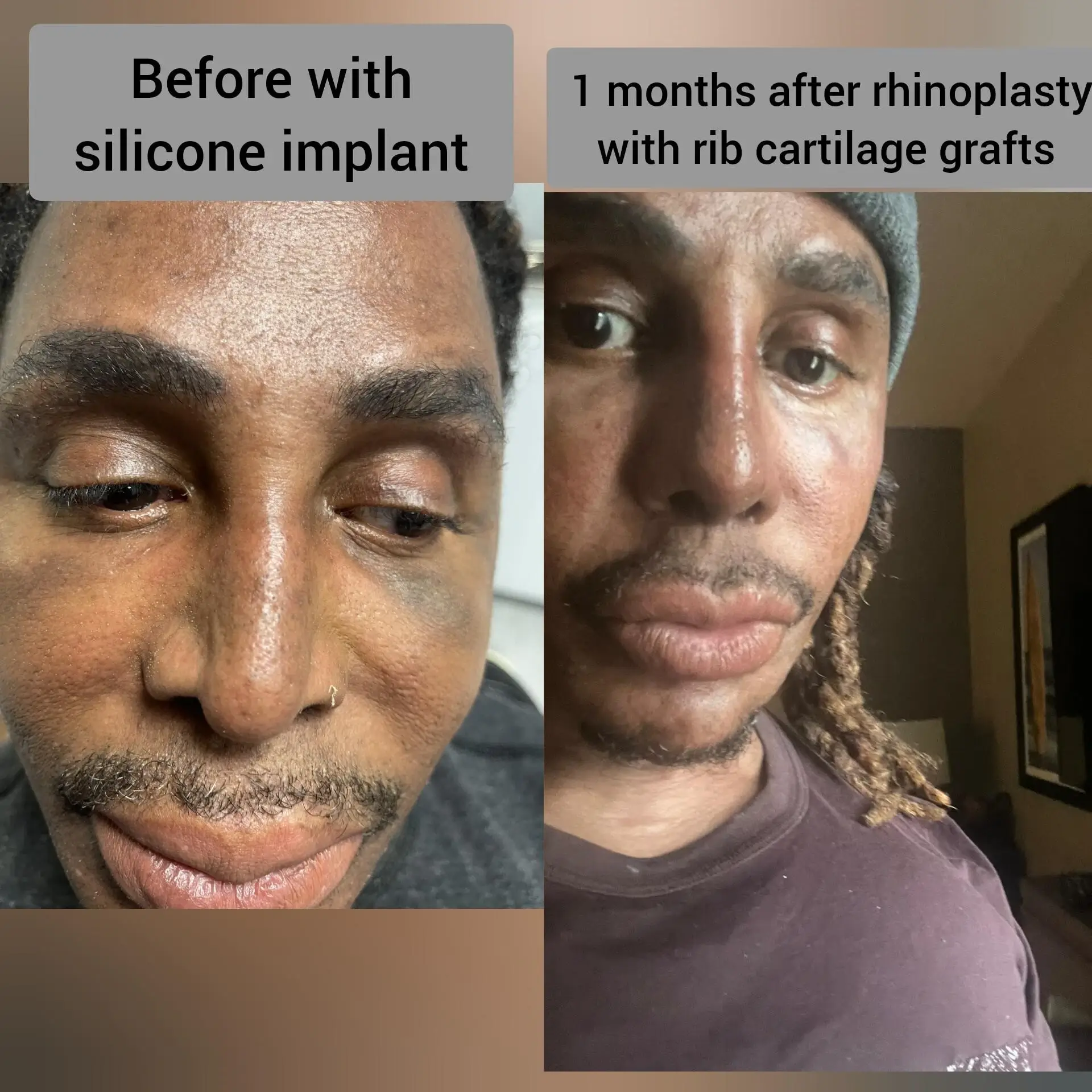Before-and-After-Ethnic-Hispanic-Male-and-Female-Rhinoplasty