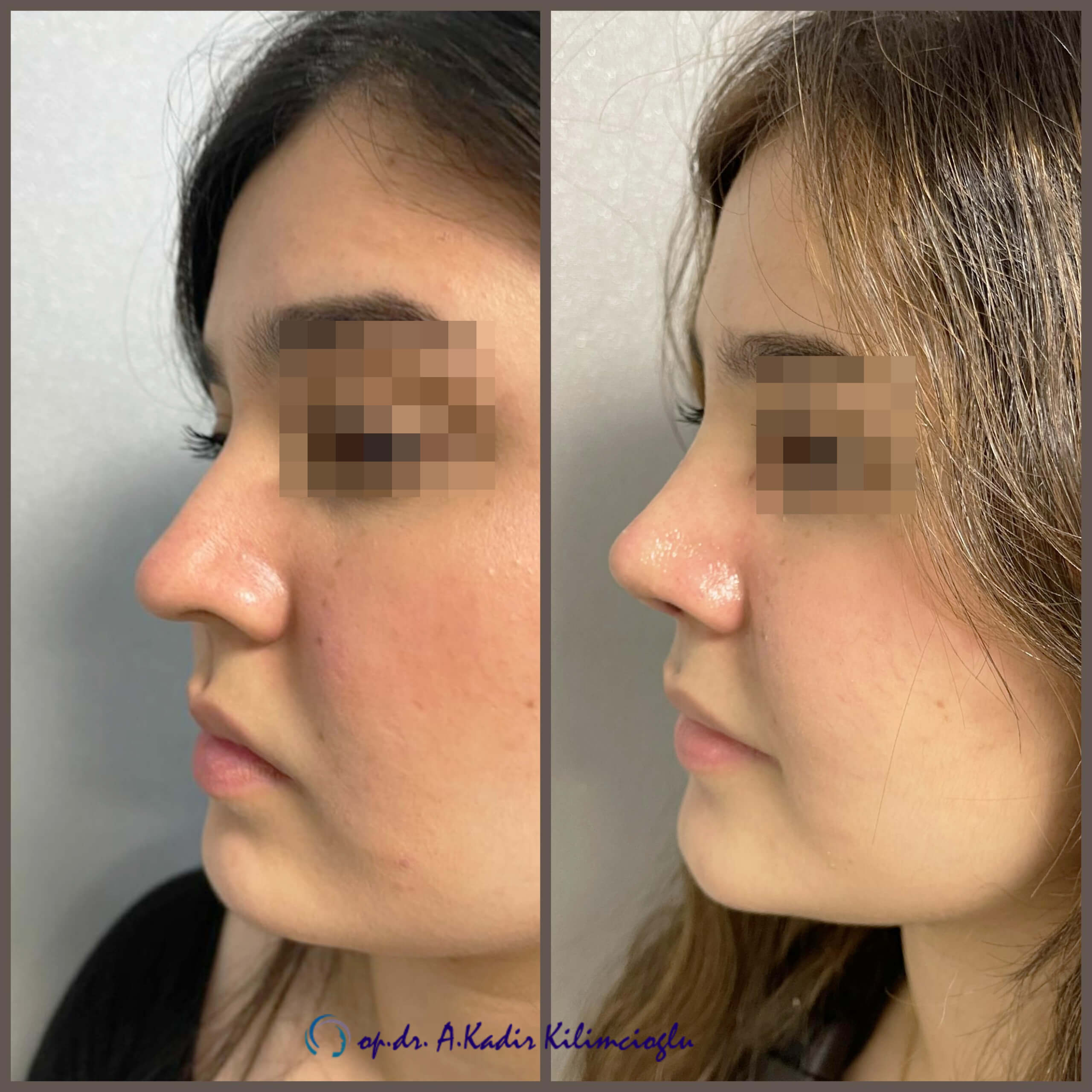 Womens Nose Aesthetics Nose Aesthetics Istanbul Nose Surgery Op Dr A Kadir Kilimcioglu
