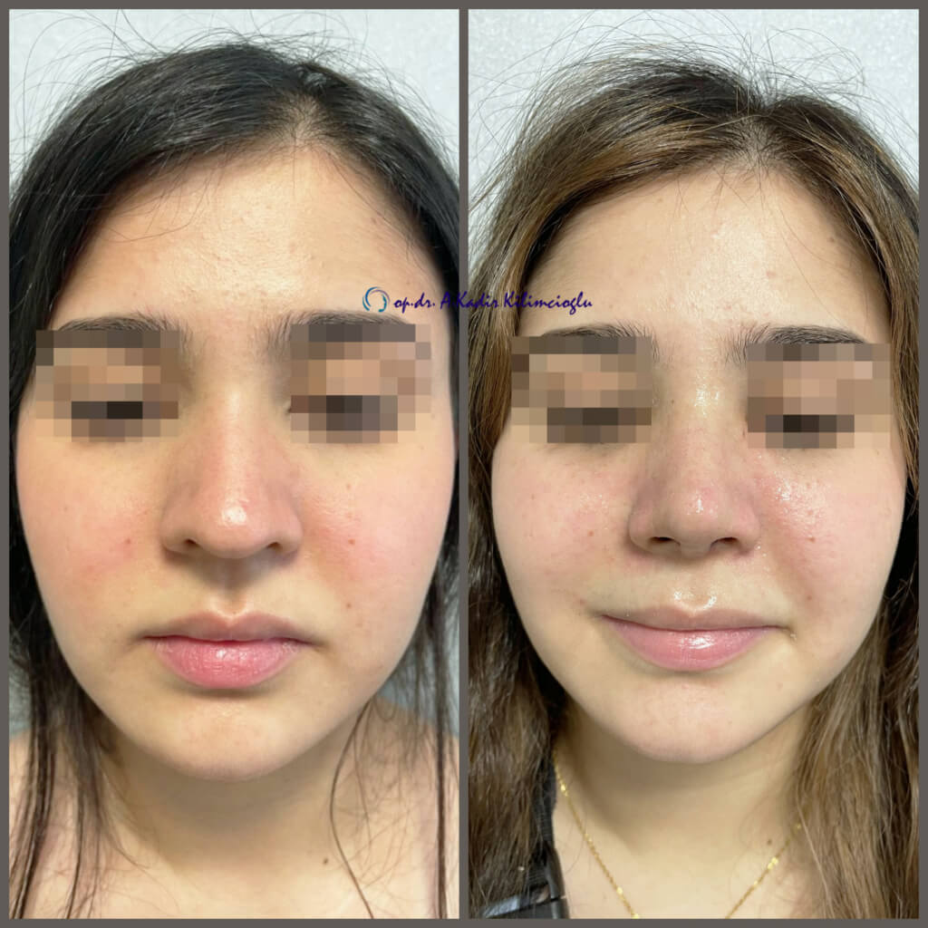 rhinoplasty-in -turkey-nose-job-before-and-after-photos-dr-kadir-kilimcioglu-57