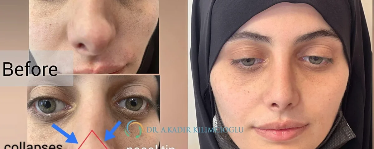 Qu’est-ce que la déformation en V inversé après une rhinoplastie