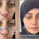 Qu’est-ce que la déformation en V inversé après une rhinoplastie