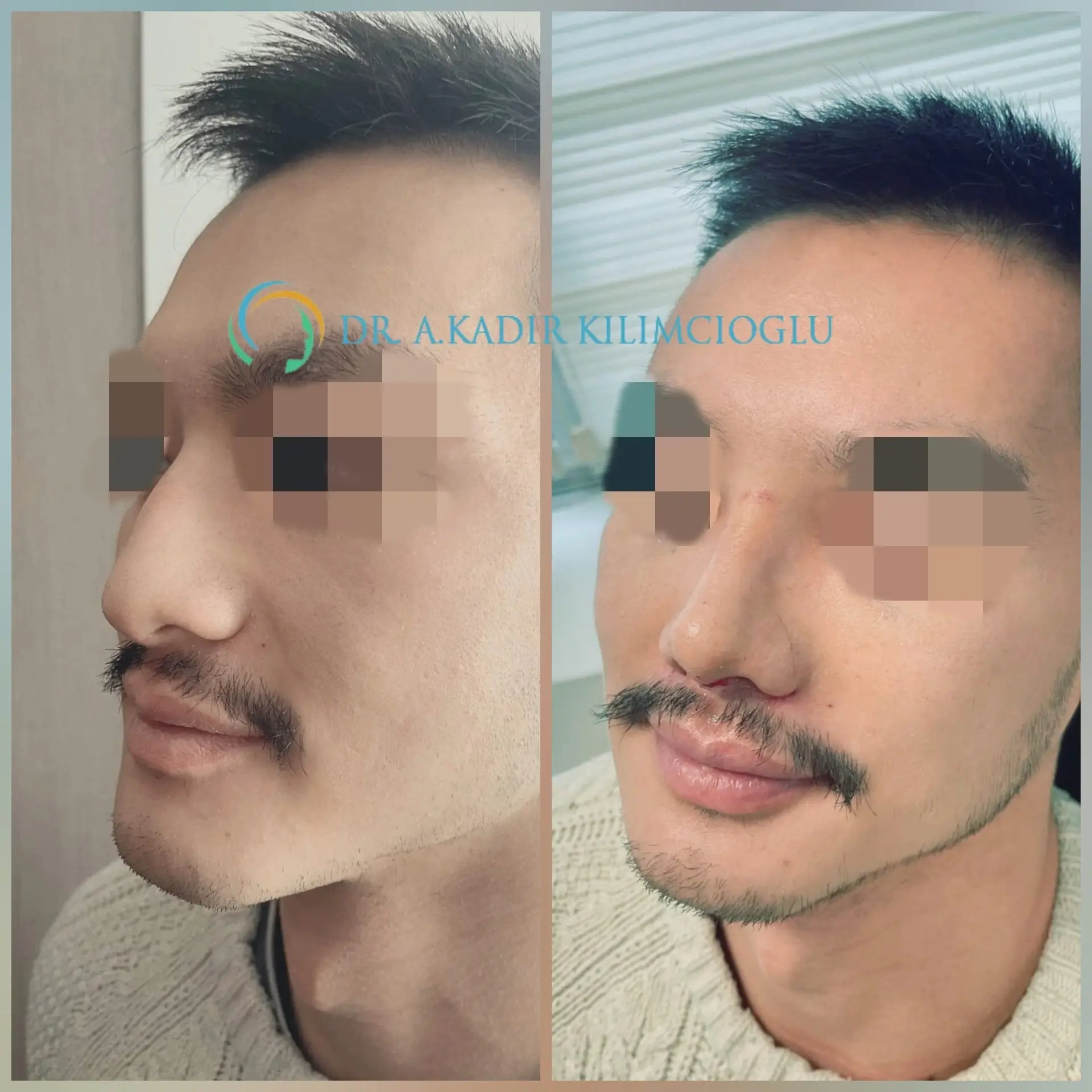 Costo de la rinoplastia asiática en Turquía 2026