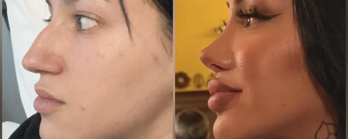 Rhinoplasty Prices in Turkey 2026: A Patient’s Guide