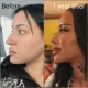 Rhinoplasty Prices in Turkey 2026: A Patient’s Guide