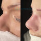 Removing a Dorsal Hump with Rhinoplasty Surgery