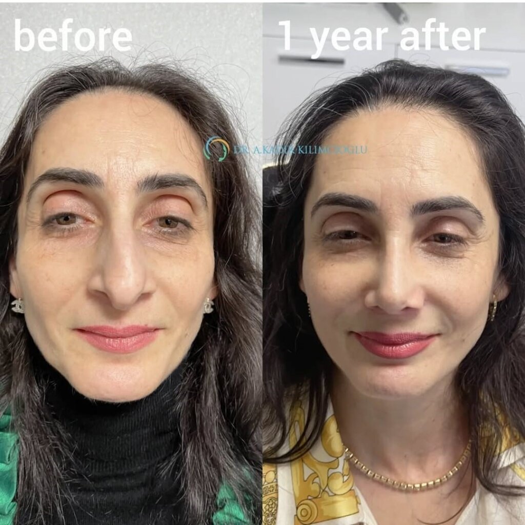 Что такое втянутая колумелла.